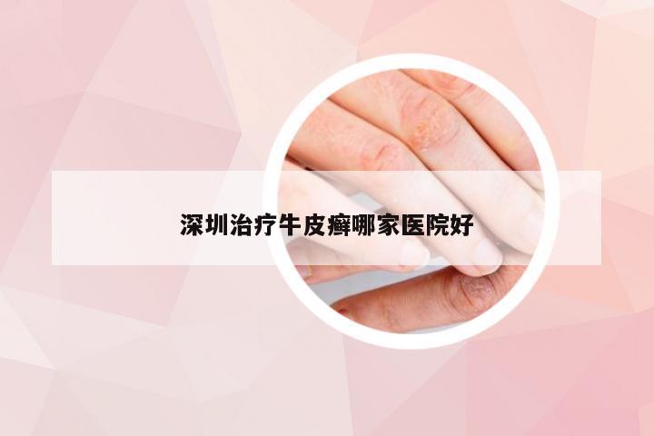 深圳治疗牛皮癣哪家医院好