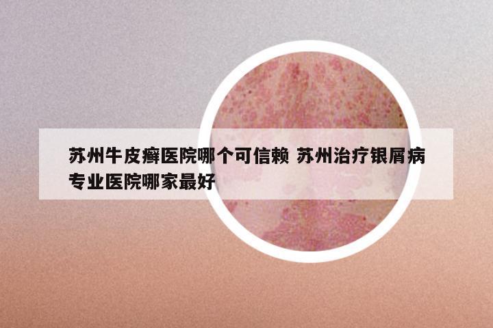 苏州牛皮癣医院哪个可信赖 苏州治疗银屑病专业医院哪家最好