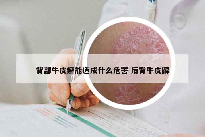 背部牛皮癣能造成什么危害 后背牛皮廨