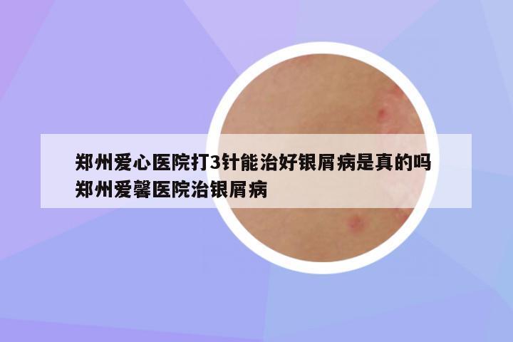 郑州爱心医院打3针能治好银屑病是真的吗 郑州爱馨医院治银屑病