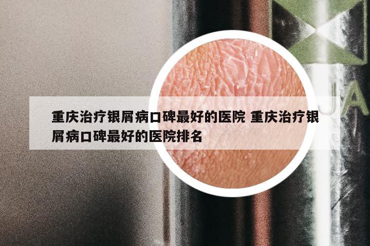 重庆治疗银屑病口碑最好的医院 重庆治疗银屑病口碑最好的医院排名