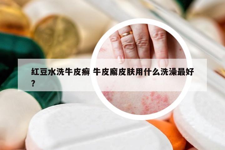 红豆水洗牛皮癣 牛皮廨皮肤用什么洗澡最好?