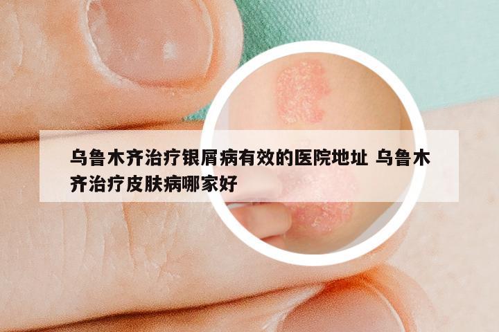 乌鲁木齐治疗银屑病有效的医院地址 乌鲁木齐治疗皮肤病哪家好