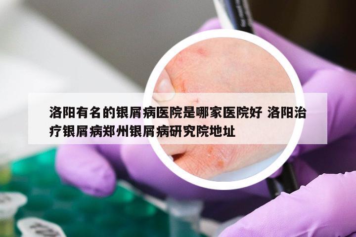 洛阳有名的银屑病医院是哪家医院好 洛阳治疗银屑病郑州银屑病研究院地址