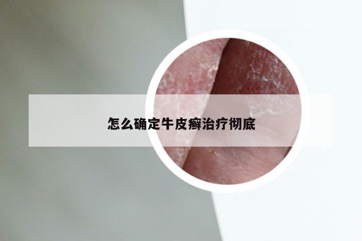 怎么确定牛皮癣治疗彻底