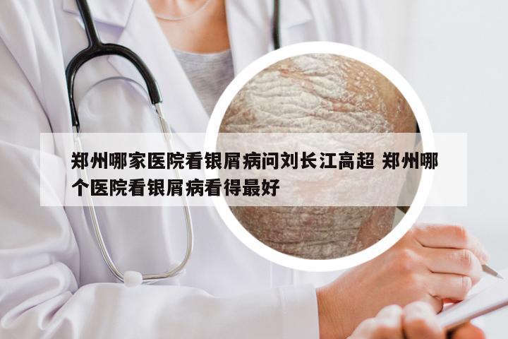 郑州哪家医院看银屑病问刘长江高超 郑州哪个医院看银屑病看得最好