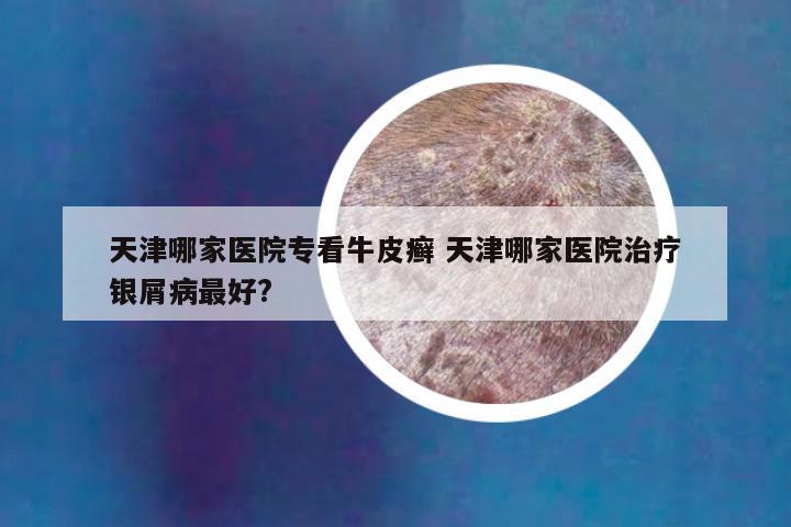 天津哪家医院专看牛皮癣 天津哪家医院治疗银屑病最好?