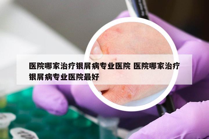 医院哪家治疗银屑病专业医院 医院哪家治疗银屑病专业医院最好