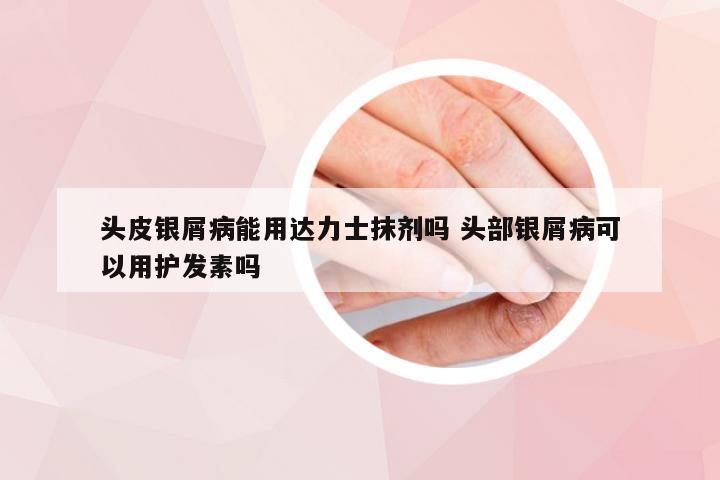 头皮银屑病能用达力士抹剂吗 头部银屑病可以用护发素吗