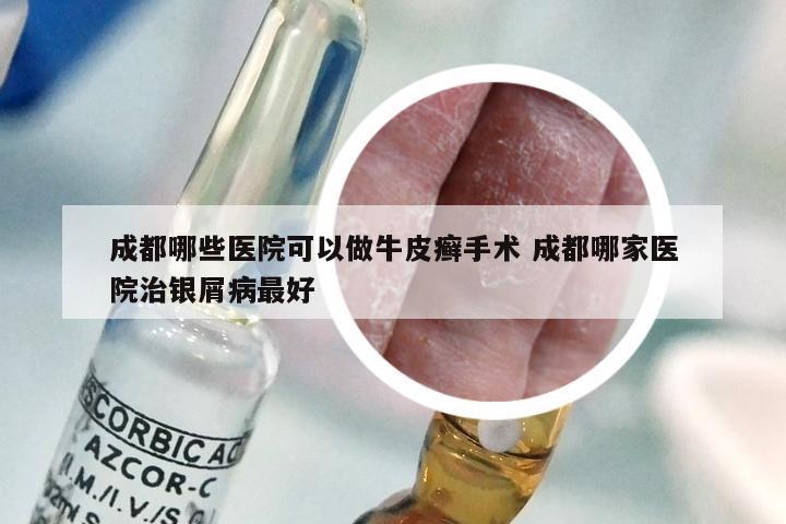 成都哪些医院可以做牛皮癣手术 成都哪家医院治银屑病最好