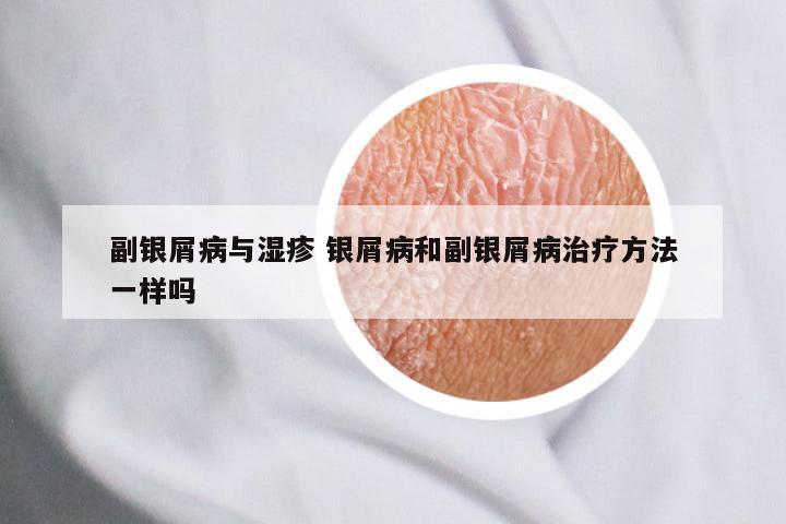 副银屑病与湿疹 银屑病和副银屑病治疗方法一样吗