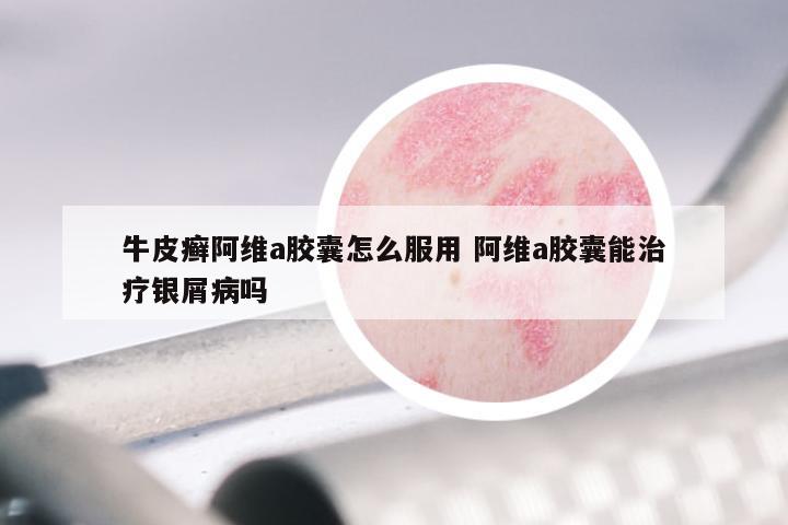 牛皮癣阿维a胶囊怎么服用 阿维a胶囊能治疗银屑病吗