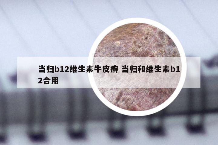 当归b12维生素牛皮癣 当归和维生素b12合用