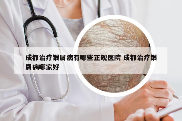 成都治疗银屑病有哪些正规医院 成都治疗银屑病哪家好