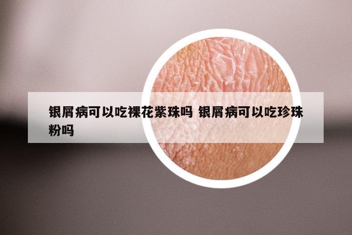 银屑病可以吃裸花紫珠吗 银屑病可以吃珍珠粉吗