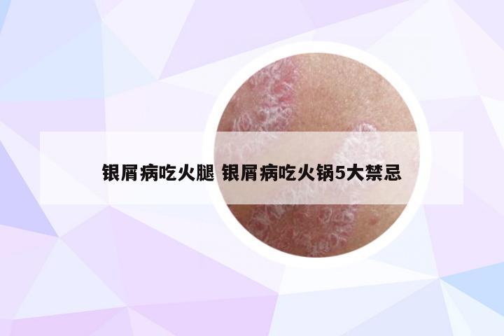 银屑病吃火腿 银屑病吃火锅5大禁忌