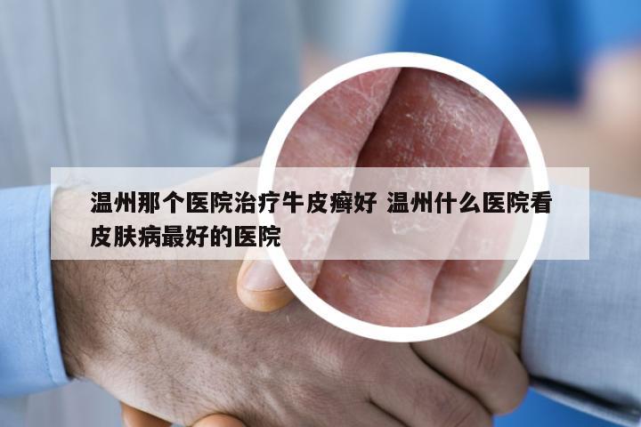 温州那个医院治疗牛皮癣好 温州什么医院看皮肤病最好的医院