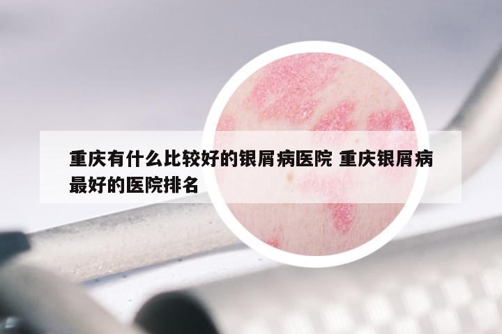 重庆有什么比较好的银屑病医院 重庆银屑病最好的医院排名