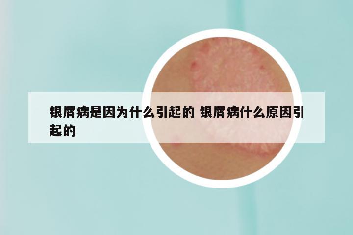 银屑病是因为什么引起的 银屑病什么原因引起的