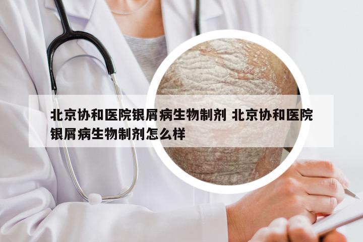 北京协和医院银屑病生物制剂 北京协和医院银屑病生物制剂怎么样