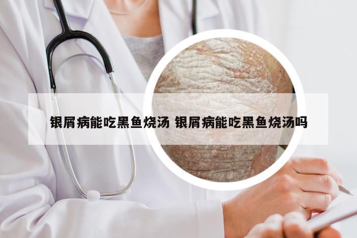 银屑病能吃黑鱼烧汤 银屑病能吃黑鱼烧汤吗