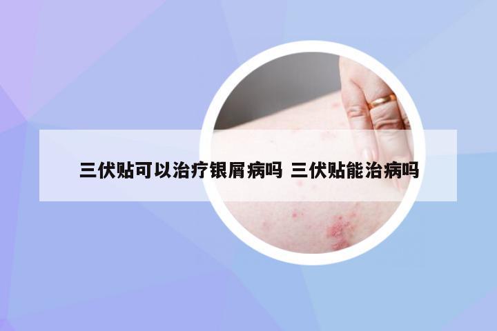 三伏贴可以治疗银屑病吗 三伏贴能治病吗