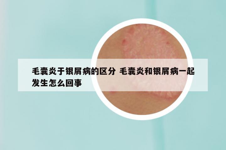 毛囊炎于银屑病的区分 毛囊炎和银屑病一起发生怎么回事