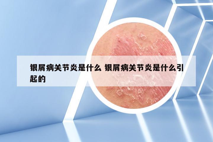 银屑病关节炎是什么 银屑病关节炎是什么引起的