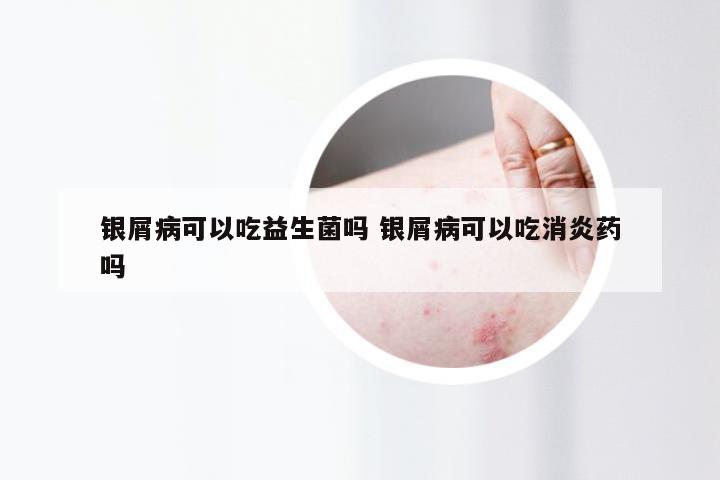 银屑病可以吃益生菌吗 银屑病可以吃消炎药吗