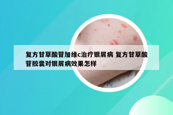 复方甘草酸苷加维c治疗银屑病 复方甘草酸苷胶囊对银屑病效果怎样