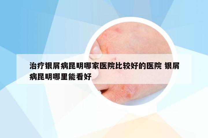 治疗银屑病昆明哪家医院比较好的医院 银屑病昆明哪里能看好