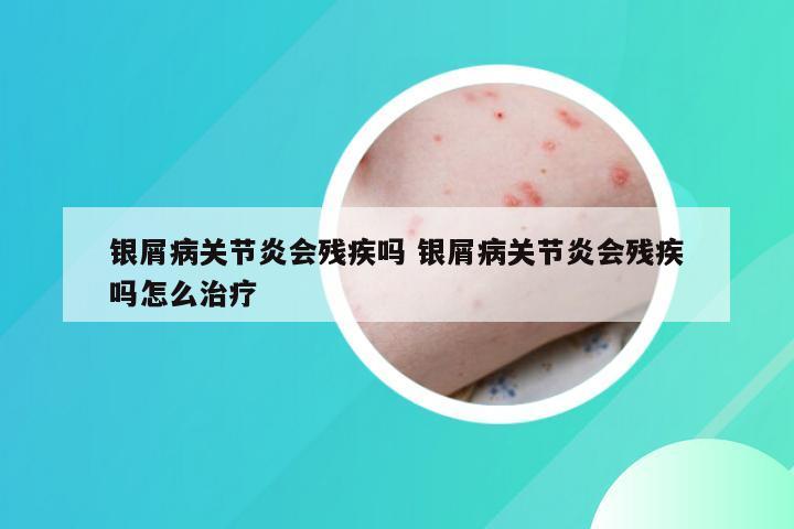 银屑病关节炎会残疾吗 银屑病关节炎会残疾吗怎么治疗