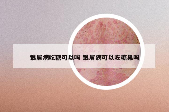 银屑病吃糖可以吗 银屑病可以吃糖果吗