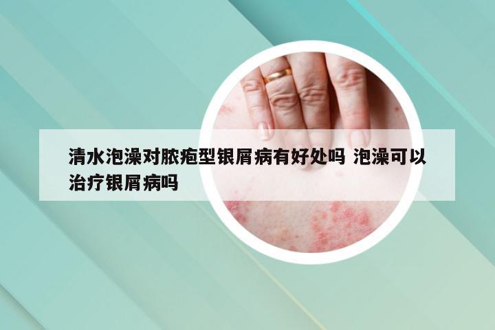 清水泡澡对脓疱型银屑病有好处吗 泡澡可以治疗银屑病吗