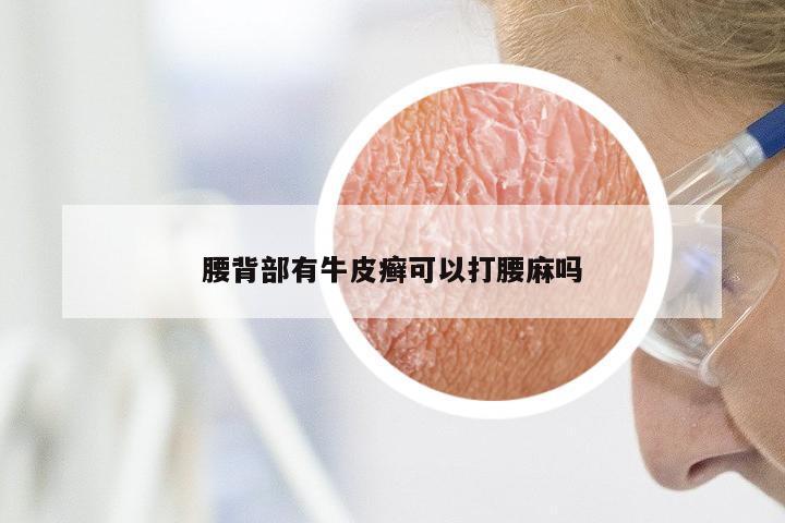 腰背部有牛皮癣可以打腰麻吗