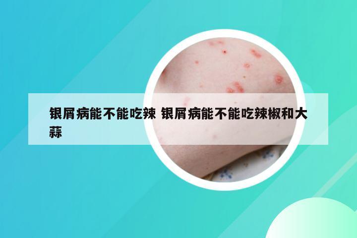 银屑病能不能吃辣 银屑病能不能吃辣椒和大蒜