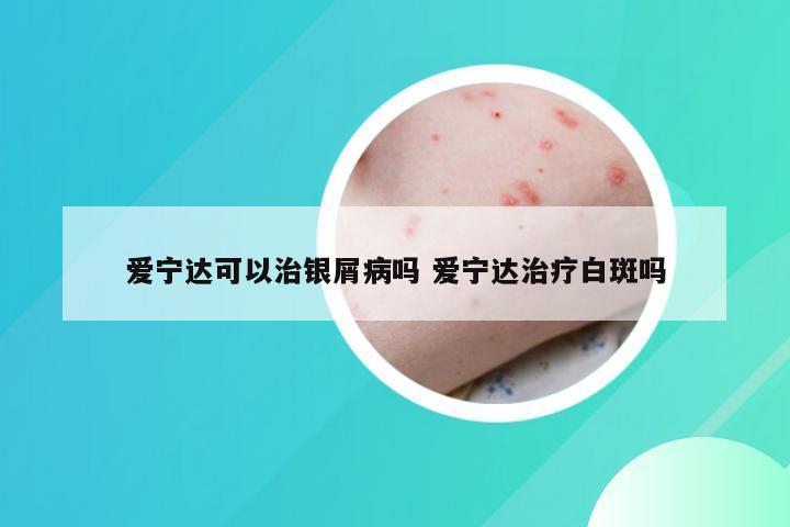 爱宁达可以治银屑病吗 爱宁达治疗白斑吗