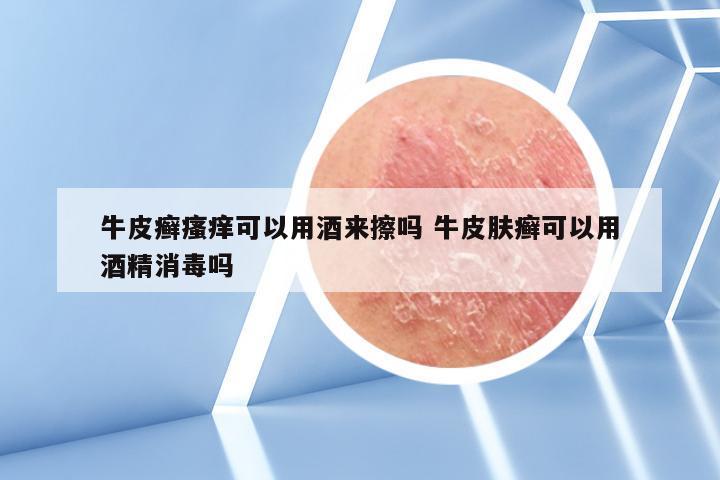 牛皮癣瘙痒可以用酒来擦吗 牛皮肤癣可以用酒精消毒吗