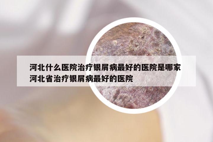 河北什么医院治疗银屑病最好的医院是哪家 河北省治疗银屑病最好的医院