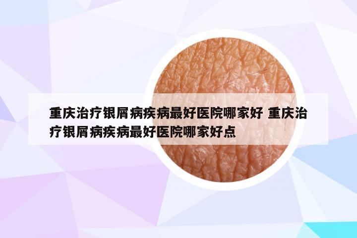 重庆治疗银屑病疾病最好医院哪家好 重庆治疗银屑病疾病最好医院哪家好点