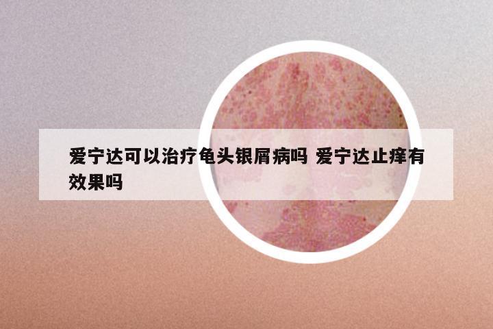 爱宁达可以治疗龟头银屑病吗 爱宁达止痒有效果吗