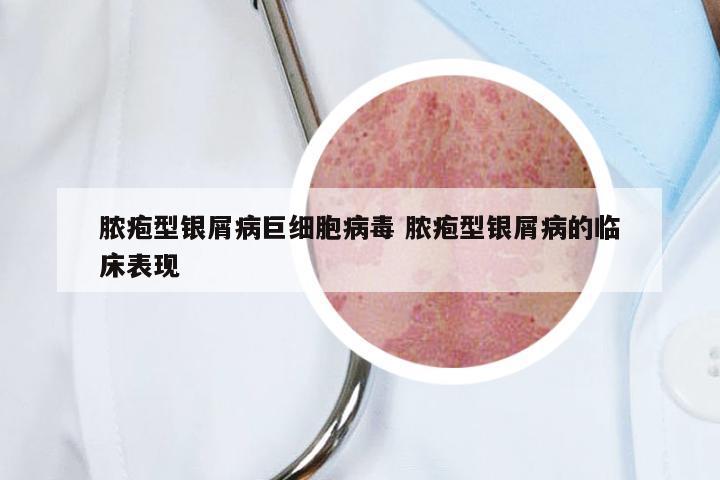 脓疱型银屑病巨细胞病毒 脓疱型银屑病的临床表现