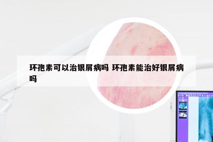 环孢素可以治银屑病吗 环孢素能治好银屑病吗