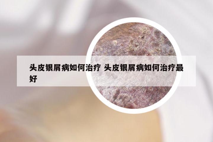 头皮银屑病如何治疗 头皮银屑病如何治疗最好