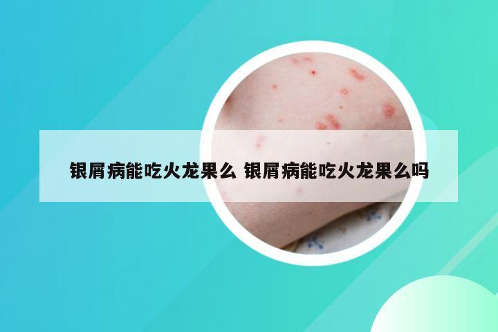 银屑病能吃火龙果么 银屑病能吃火龙果么吗