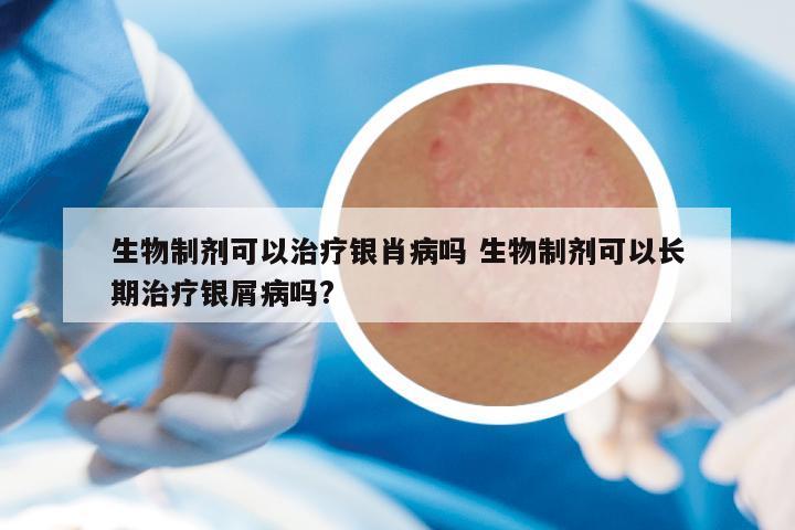 生物制剂可以治疗银肖病吗 生物制剂可以长期治疗银屑病吗?