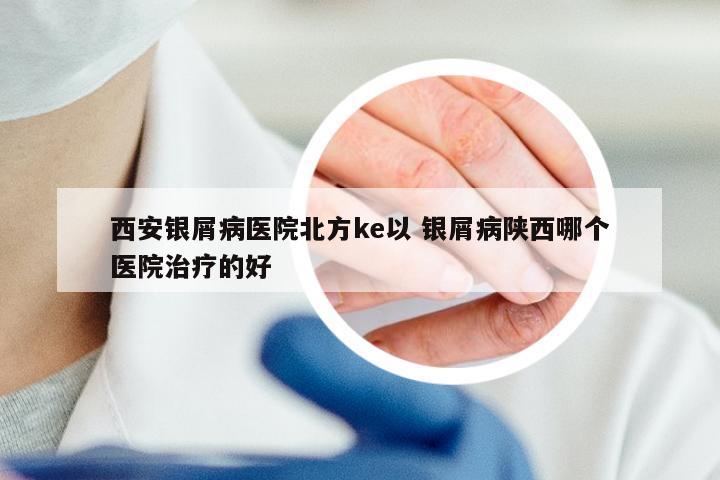 西安银屑病医院北方ke以 银屑病陕西哪个医院治疗的好