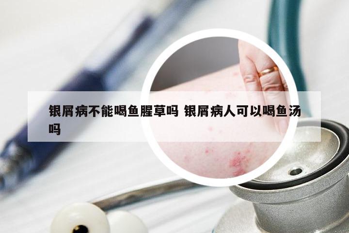 银屑病不能喝鱼腥草吗 银屑病人可以喝鱼汤吗