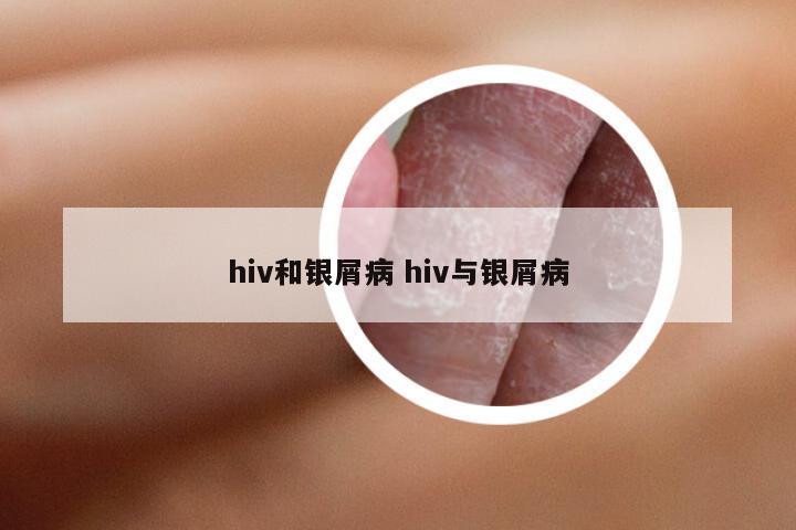 hiv和银屑病 hiv与银屑病