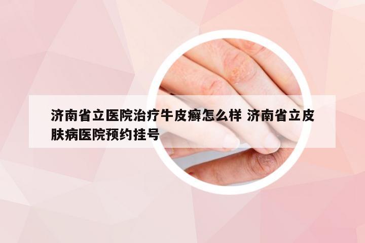 济南省立医院治疗牛皮癣怎么样 济南省立皮肤病医院预约挂号